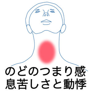 喉のつまり・ヒステリー球の症例１