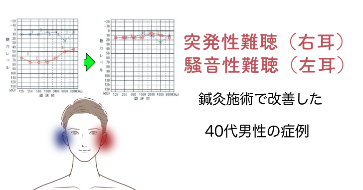 突発性難聴騒音性難聴症例