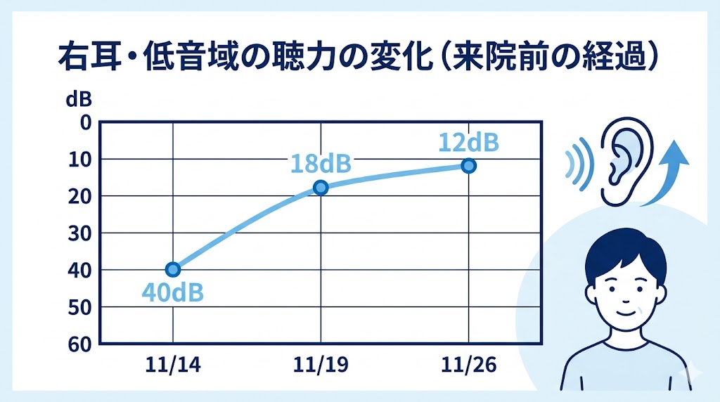 右耳・低音域の聴力の変化（来院前の経過）40dBから12dBへ回復したオージオグラムのグラフ